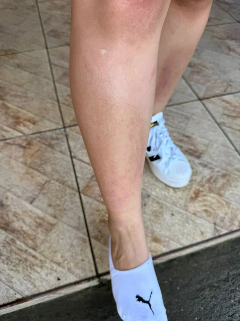 Alergia perna depois