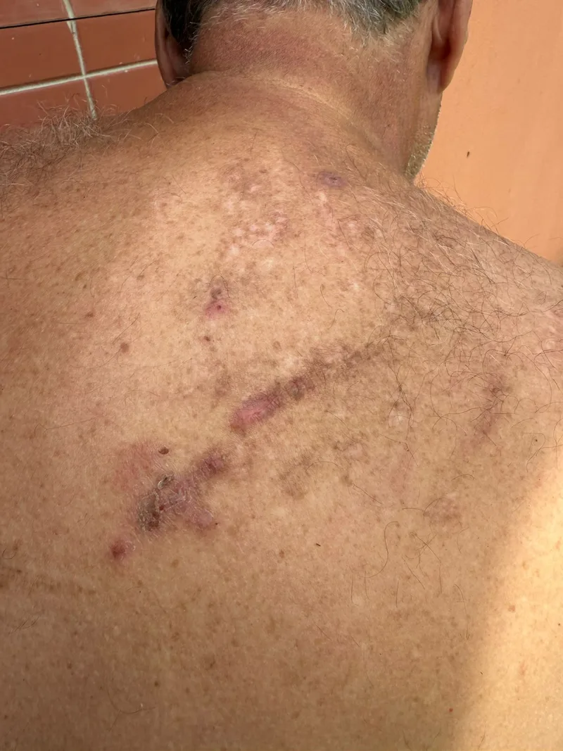 Alergia costas depois